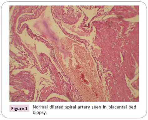 Spiral Arterial Morphology In Relation To Hypertension In Pregnan