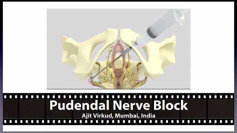 Pudendal Nerve Block YouTube