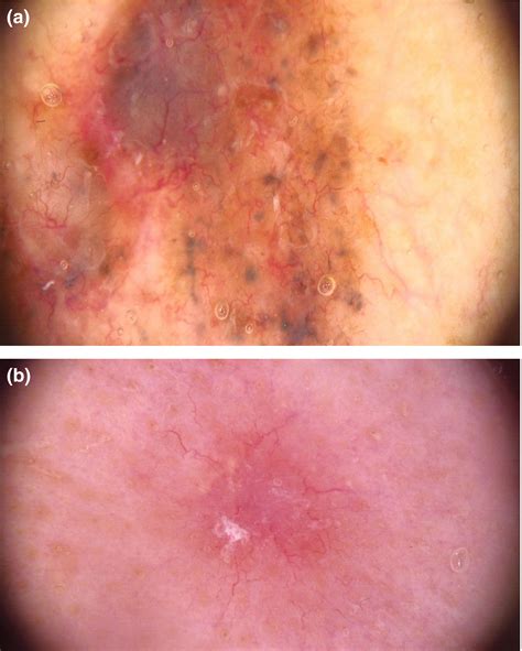 Dermoscopy Of Basal Cell Carcinoma Wozniak‐rito 2018 Clinical And