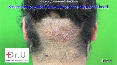 Acne Keloidalis Nuchae Free Consultation - Dr. U Hair & Skin Clinic ...