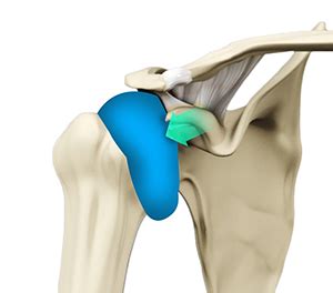 Shoulder Synovitis Irving, TX | Rheumatoid Arthritis Southlake, TX