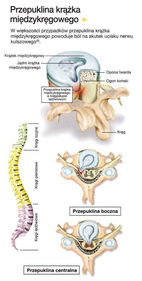 Przepuklina Kr Gos Upa