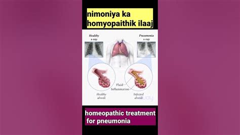 nimoniya ka homyopaithik ilaaj !! homeopathic treatment for pneumonia ...