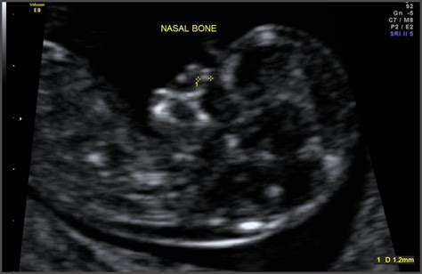 11 Week Ultrasound Pictures