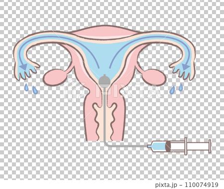 卵管造影検査の様子 卵管の通りが良い子宮のイラスト 説明図 文字なしのイラスト素材 110074919 PIXTA