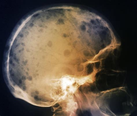 Skull In Bone Marrow Cancer X Ray Photograph By Zephyr Fine Art America