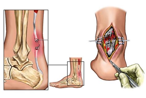 Il Tendine D Achille Rottura E Riabilitazione Formative Zone
