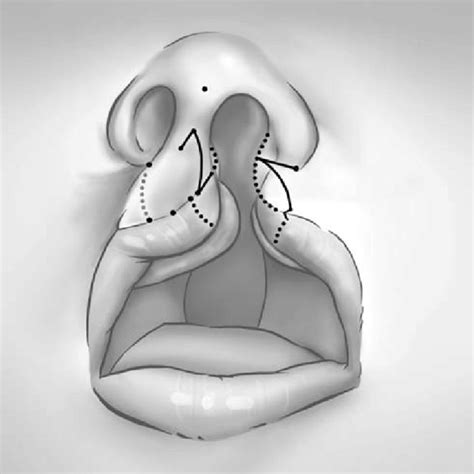 Pdf Unilateral Cleft Lip And Nose Repair