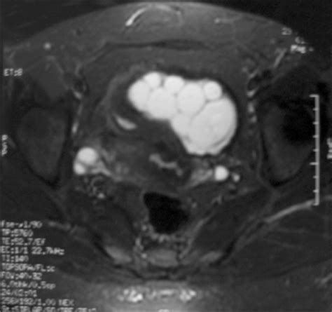 Pelvic Mri Revealed A Septated Lobulated And Contrast Open I