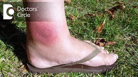 Photos Of Spider Bites On Foot Clearance