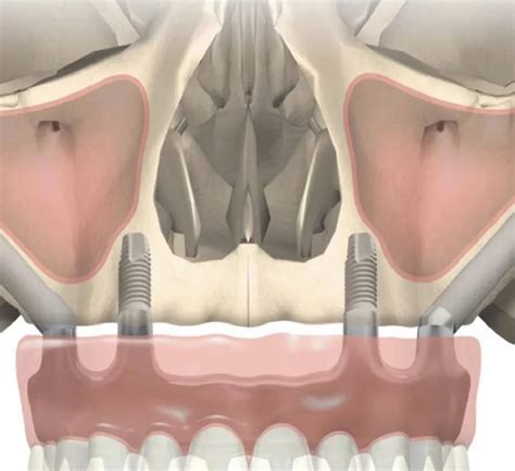 Oral And Maxillofacial Services Maxillo 3 Lacs