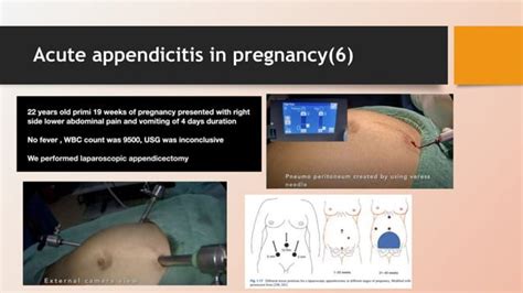 Acute Abdomen During Pregnancy 複本