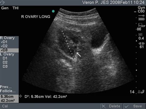 Transabdominal Longitudinal View Of Right Ovary With Multiple Internal