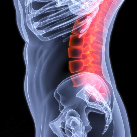 SIB #445- Pain and Lumbar Spine Osteoarthritis — MATLIN