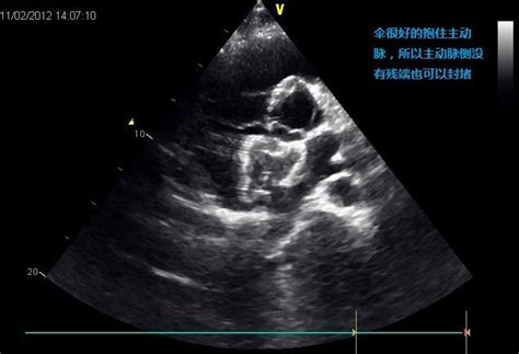 教你读心脏彩超之房间隔缺损 知乎