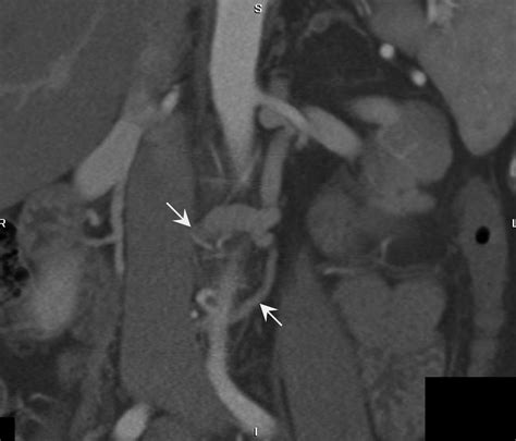 Utility Of 16 Mdct Angiography For Comprehensive Preoperative Vascular