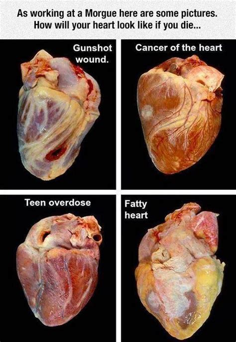 551 Best Cardiovascular System Images On Pinterest Anatomy Physical