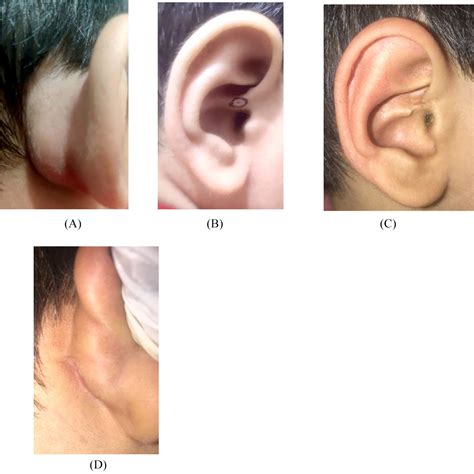 The Variant Type Of Preauricular Sinus With Recurrent Postauricular Abscess Excision By Single