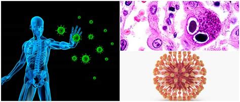 Citomegalovirus S Ntomas Tipos Tratamiento Prevenci N Causas