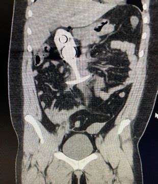 Person Impaled By Butt Plug While Wearing It During An MRI Suing Maker Of Sex Toy EBaum S World
