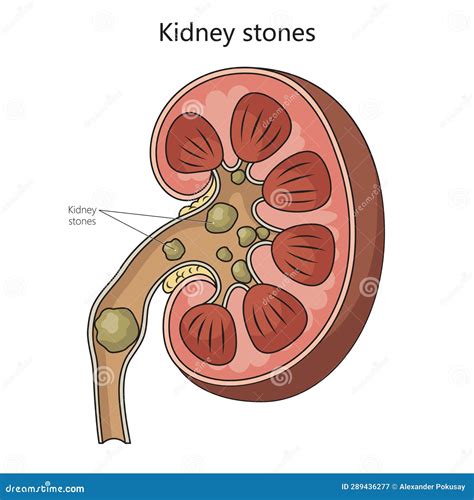 Kidney Stone Disease Medical Science Stock Vector - Illustration of