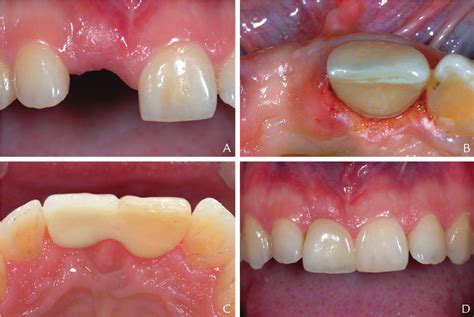 A 18 Year Old Woman With Edentulous Space After Traumatic Loss Of