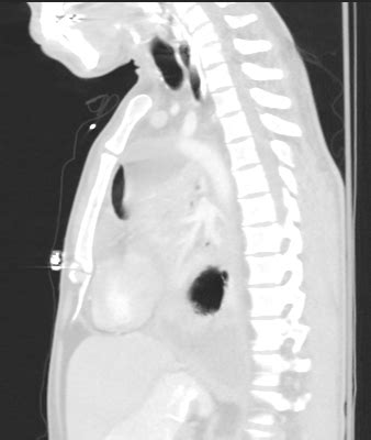 Esophageal Perforation With Large Hydropneumothorax Image