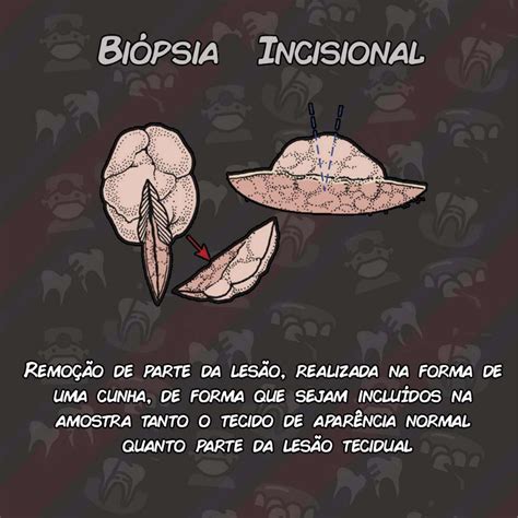 Bi Psias Em Odontologia Incisional Excisional Punch Aspira O