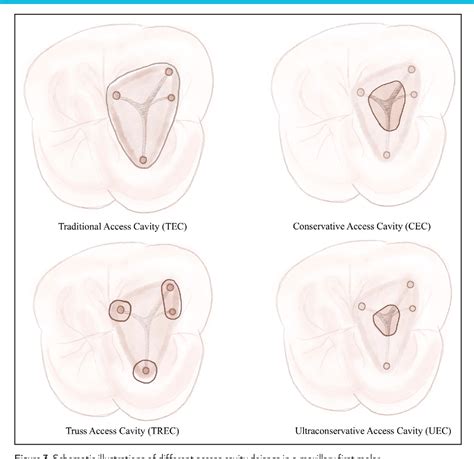 Figure 3 From A Literature Review Of Minimally Invasive Endodontic