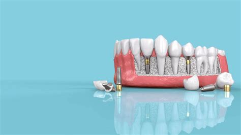 Immediate Dental Implants Chic Dental