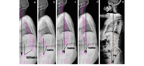 Computerized Planning In Flat Back Deformity After T3 S1 Arthrodesis