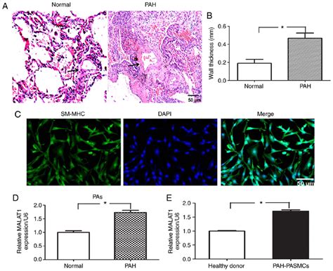 Malat1 Is Upregulated In Pa Tissues And Hpasmcs From Patients With Pah