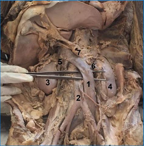 Inferior Vena Cava