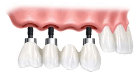 Implante Dentário O Guia Absolutamente Completo MD Odontologia