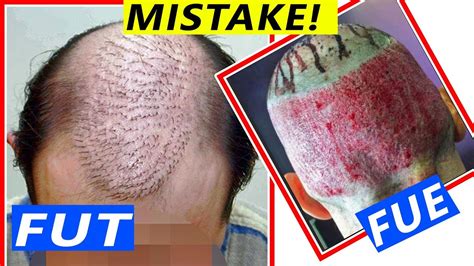 Failed Hair Transplant Results Be Careful Youtube