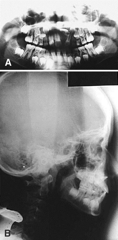 Treatment Of An Impacted Dilacerated Maxillary Central Incisor