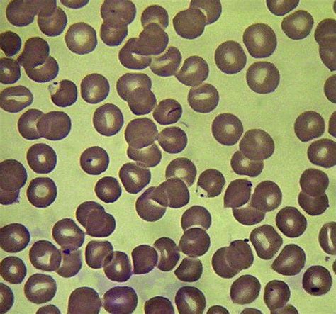 E Plasmodium Falciparum Infection Leishman Giemsa Stain