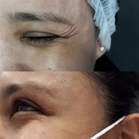 Rejuvenecimiento Facial Con Hasta Off Palavas