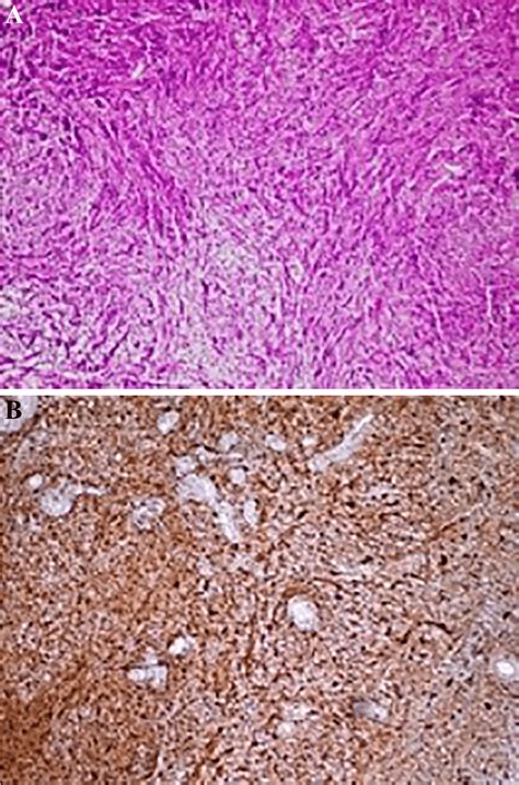 Histological Analysis Of The Mass A Hematoxylin And Eosin Staining