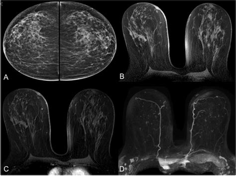 Fast MRI Breast Cancer Screening Ready For Prime Time Clinical Imaging