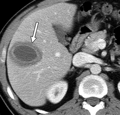 Amebic Liver Abscess As Related To Leflunomide Pictures