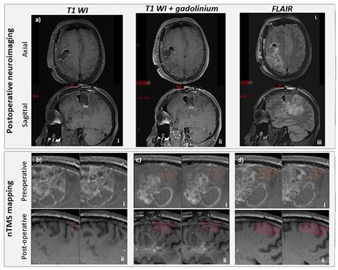 Frontiers Case Report Multimodal Functional And Structural