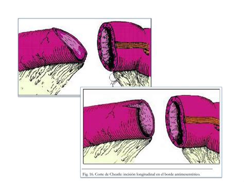 Anastomosis Intestinales PPT Descarga Gratuita