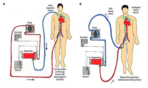 A The Modality Of Vv Ecmo The Most Frequently Used Modality Of