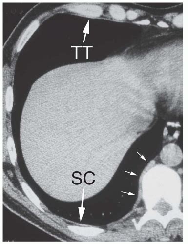 The Pleura And Pleural Disease Radiology Key