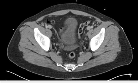 Ct Abdomen And Pelvis With Iv Contrast Demonstrating A 13 X 08 Cm Download Scientific Diagram