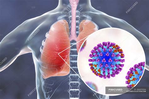 Human Silhouette With Lungs Infected By Pneumonia Caused By Flu