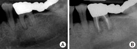 Mandibular Periapical Radiograph