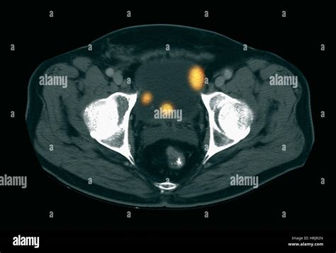 Bladder Cancer Ct Scan Stock Photo Alamy