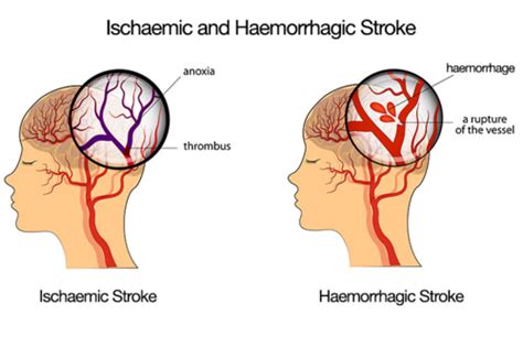 Nursing CVA Stroke Flashcards Quizlet